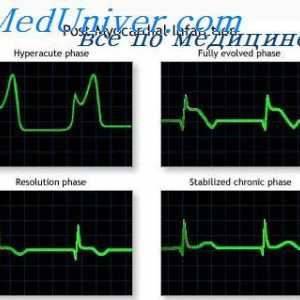 Akutní fáze infarktu přední stěny. Infarkt myokardu zadní stěny na EKG
