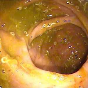 Pinworms ve střevě, konečníku, řitního otvoru střevní enterobiosis