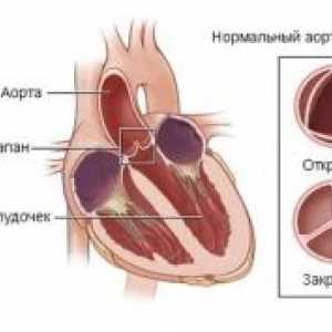 Akutní dysfunkce srdečních chlopní