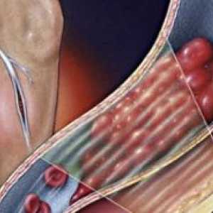 Akutní trombóza hlubokých žil dolních končetin: léčba, symptomy
