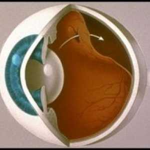 Odloučení sítnice očí: příčiny, příznaky, léčba, symptomy