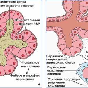 Pankreatitida - onemocnění slinivky břišní: příčiny, etiologie, patogeneze, klinické příznaky, léčba