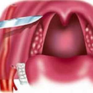 Peritonzilární absces: léčba, příznaky, příčiny, příznaky