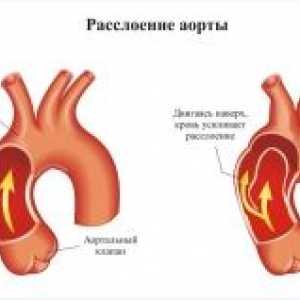 Aortální patologie v těhotenství
