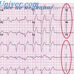Angina pectoris a infarktu na EKG. Změny v vlny T na elektrokardiogramu