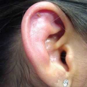 Perichondrium ucha: léčba, příznaky, znaky, příčiny
