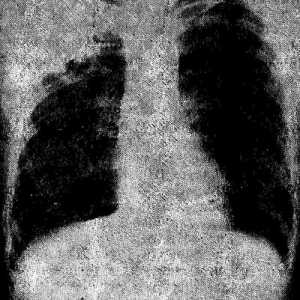 Pneumonie prodloužena kurz. RTG vyšetřovací metody