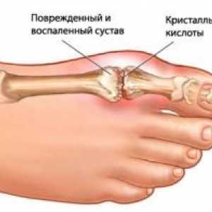 Dnavá artritida kloubů: léčba, příznaky, znaky, příčiny