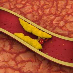 Slinivka břišní a cholesterol