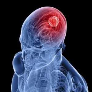 Nemoci zrakové dráhy u nádorů mozkových hemisfér