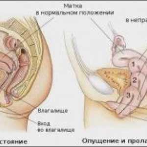 Malformace dělohy: diagnostika a léčba