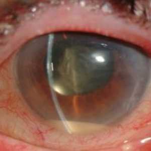 Pooperační Endoftalmitida oči
