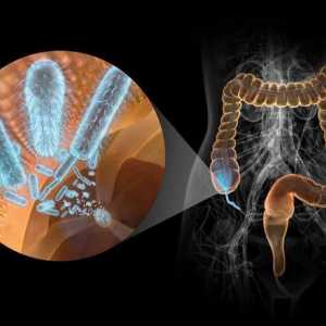 Příčiny ulcerózní kolitidy