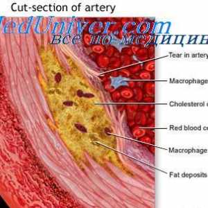 Prevenci aterosklerózy. vlastnosti aminokyselin