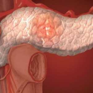 Prevence a léčba onemocnění slinivky břišní a chronická pankreatitida