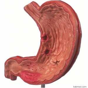 Projevy žaludku žaludku, jsou příznaky?