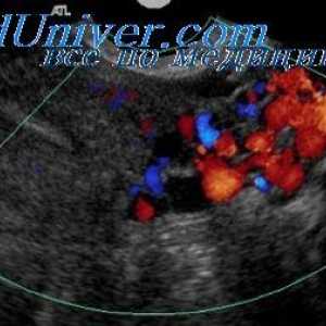 Prodloužené formy aspirin těhotným ženám. barevný Doppler