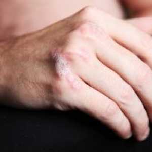 Psoriatické artropatie, léčba, příznaky, znaky, příčiny