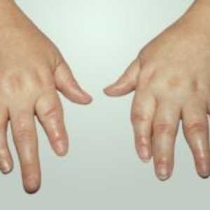 Psoriatické artritidy: léčba, příznaky, diagnostika, příznaky, příčiny