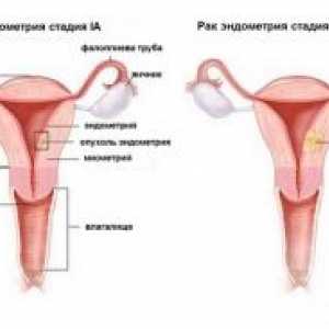 Rakovina endometria: symptomy, stupeň, léčení, diagnózu, prognózu, příčiny, příznaky, prevence