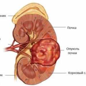 Karcinomu ledvinové pánvičky a močovodu: příznaky, symptomy, příčiny, léčba