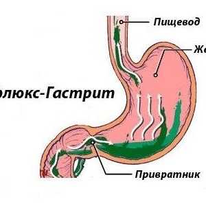 Reflux gastritida: Známky, příznaky a léčba