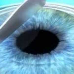Refrakční oční chirurgii: co je to?