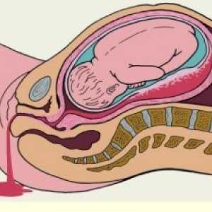 Krvácení z konečníku v průběhu těhotenství