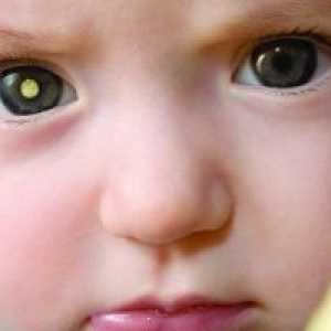 Retinoblastom u dětí: příznaky, léčba, příčiny, příznaky