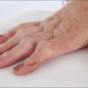 Revmatoidní artritida prstů: příznaky, léčba, příčiny, příznaky
