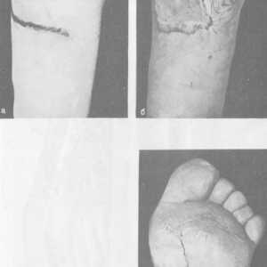 Scar deformity nohy a kotníku. Vředy na povrchu plosky nohy oblouku