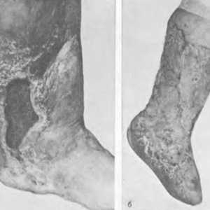 Scar deformity nohy a kotníku. Jizvy v oblasti kotníku
