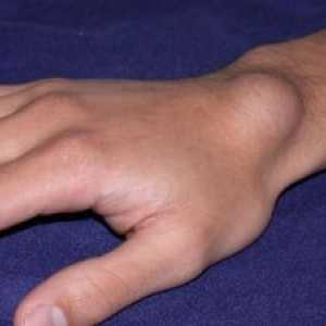 Sarkom měkkých tkání na ruce a zápěstí oblasti: příčiny, léčba