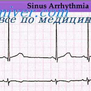 Srdeční arytmie. Porušení rytmu sinusovém uzlu