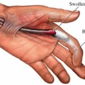 Trigger finger: příčiny, léčba, příznaky, příznaky, prevence
