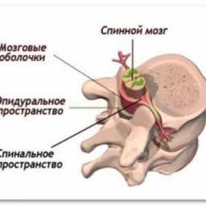 Spinální epidurální absces: léčba, příčiny, prevence
