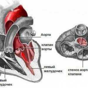 Aortální stenóza, ústech, léčba, příčiny, příznaky, znaky