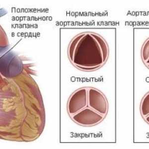 Aortální stenóza