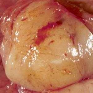 Žaludeční gastrointestinální stromální tumor (GIST, hist)