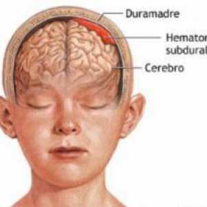 Subdurální hematom mozku: Důsledky ošetření