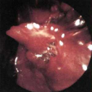 Torakoskopická diagnostika a léčba uzavřené trauma hrudníku