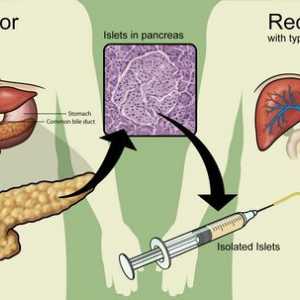 Transplantace pankreatu