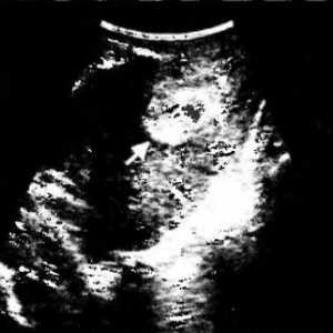Transvaginální ultrazvuk diagnóza poporodní endometritidy