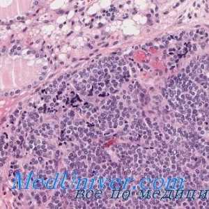 Tuberkulóza štítné morfologie, patologické anatomie