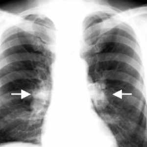 Tuberkulóza nitrohrudních mízních uzlin: léčbu, komplikace, příčiny, příznaky