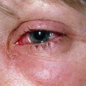 Modřiny a zraněných očí: léčba, první pomoc, příčiny, příznaky, znaky