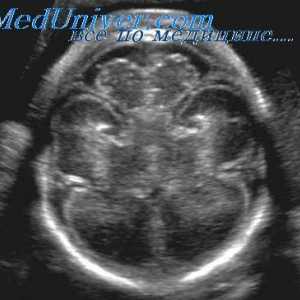 Prenatální péče s ventrikulomegalie. vrozený hydrocefalus