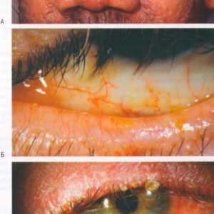 Onemocnění spojivky oční rosacea