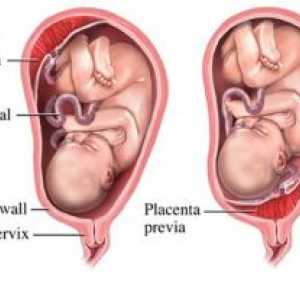 Zpoždění v děloze a placentě jeho částí